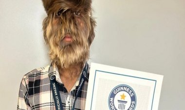 चेहरे पर घने बाल वाले रतलाम के ललित पाटीदार का नाम गिनीज बुक ऑफ वर्ल्ड में दर्ज