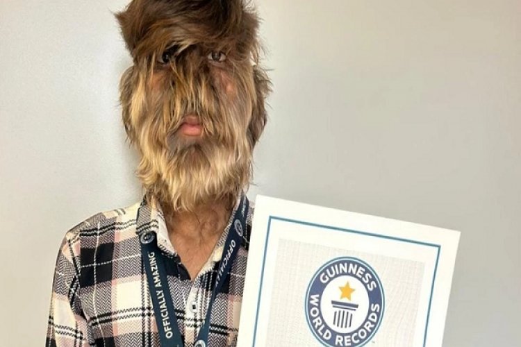 चेहरे पर घने बाल वाले रतलाम के ललित पाटीदार का नाम गिनीज बुक ऑफ वर्ल्ड में दर्ज