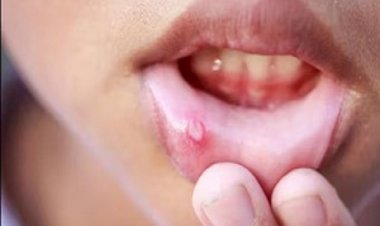 अगर मुंह में हो गए हैं छाले