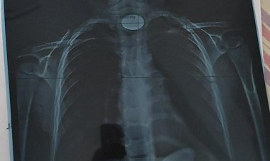 बच्चों को सिक्का, पिन, सुई, कांच, छोटी गिट्टी या छोटी वस्तुओं से दूर रखें : डॉ. प्रशांत सिंह