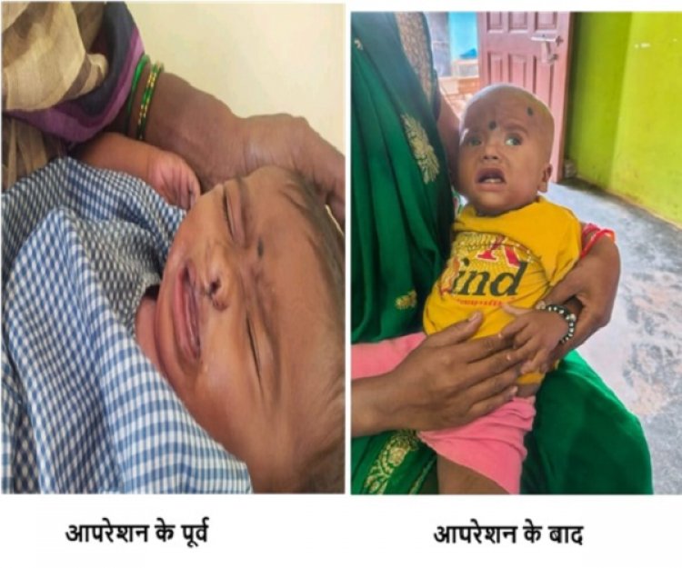 रायपुर : चिरायु योजना बच्चों के लिए भी बनी वरदान